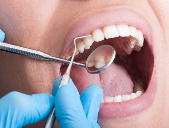 A closeup of a patient receiving a teeth cleaning