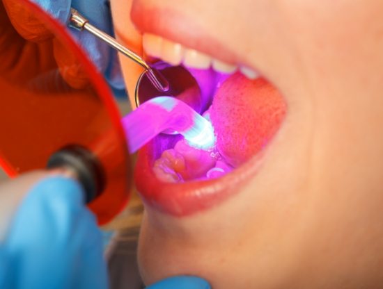 Close up of dental patient receiving dental bonding on lower tooth