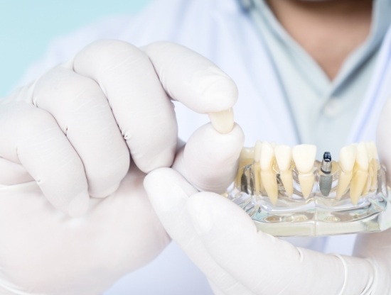 Dentist holding a crown in one hand and a dental implant model in the other