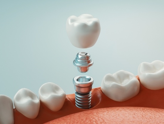 Illustrated model of a dental implant in Rocky Hill