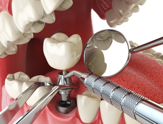 Illustration of dental implant replacing a missing lower tooth