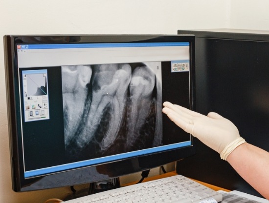Dentist gesturing to computer screen showing digital x ray of teeth