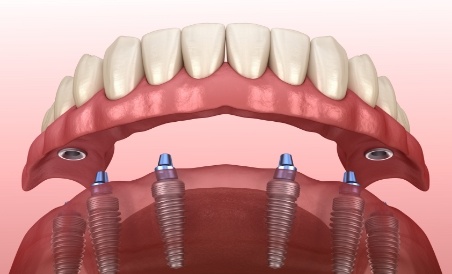 Illustrated full denture being fitted over six dental implants