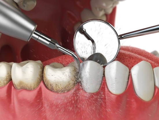 Illustrated dental scaler removing plaque from teeth during gum disease treatment