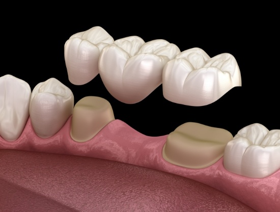 Illustrated dental bridge replacing a missing tooth in Rocky Hill