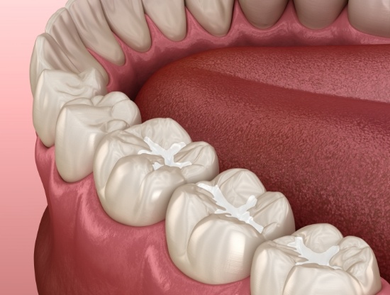 Illustrated row of teeth with white dental sealants