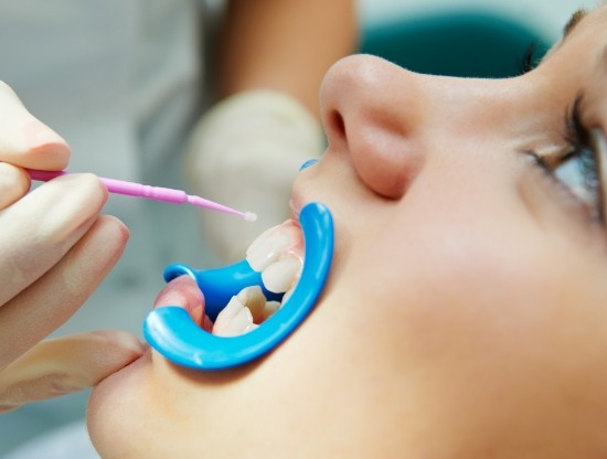 Close up of dental patient having fluoride applied to their teeth