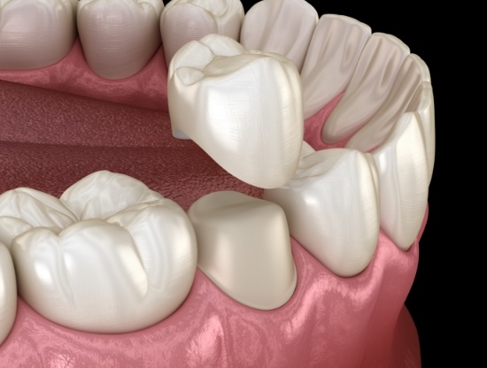 Illustrated dental crown being placed over a tooth