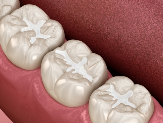 Illustrated row of teeth with white fillings