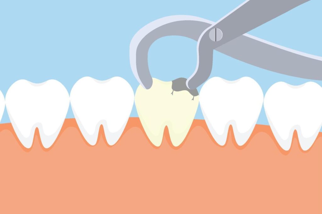tooth extraction illustration